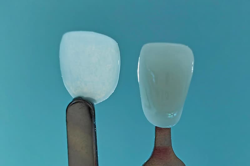 World's Thinnest Dental Veneers producing by 3D printing by Boston Micro Fabrication